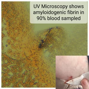 90% blood tested poisoned with amyloidogenic fibrin